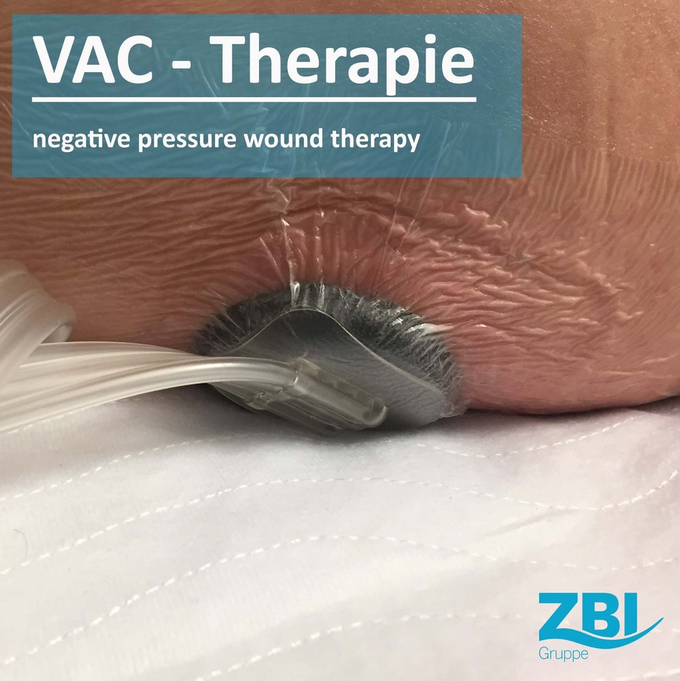 Titelbild des Blogposts VAC-Therapie mit einem angelegten VAC-Verband an einer Wunde