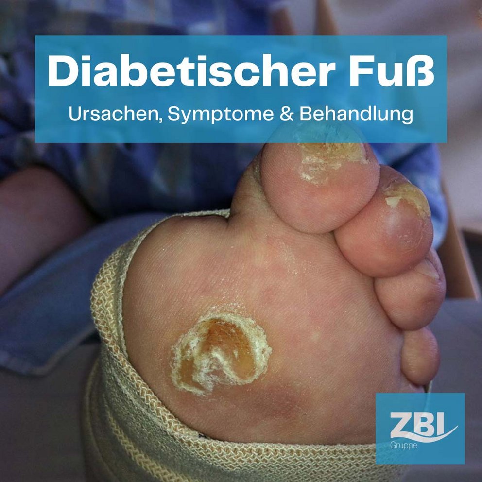 Titelbild Blogbeitrag diabetischer Fuß. Im Hintergrund Fußsohle mit einem Malum perforans, ein typisches neuropathisches Ulkus der Fußsohle bei diabetischem Fuß