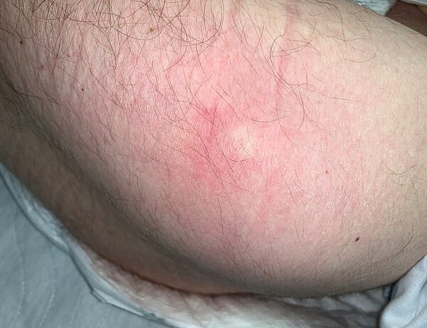 Foto eines Erythems, das im Rahmen der Dekubitusprophylaxe beobachtet werden sollte.