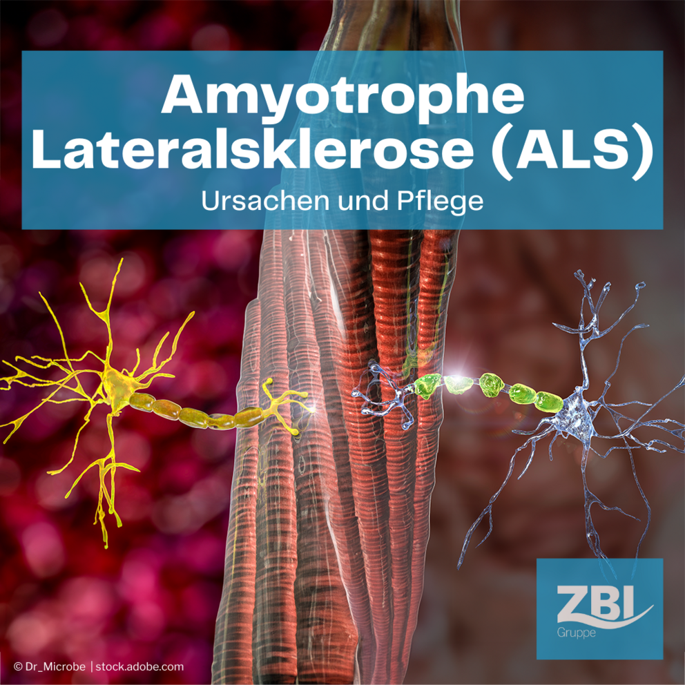 Vorschaubild zum Blogbeitrag ALS mit Einer intakten Nervenzelle (links) im Vergleich zu einer beschädigten Nervenzelle (rechts), wie es z.B. bei ALS auftritt