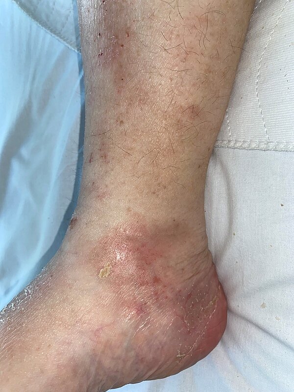 Knöchel eines Patienten mit Ulcus Cruris Grad 2b und Ödemen.