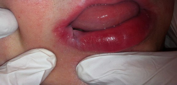 Dekubitus im Mundbereich eines Patienten (Schleimhautdruckschädigung).