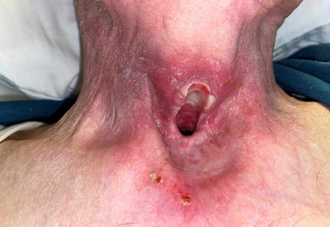 Halsbereich eines Patienten mit einem Dekubitus Kategorie 4 verursacht durch eine Tracheotomie