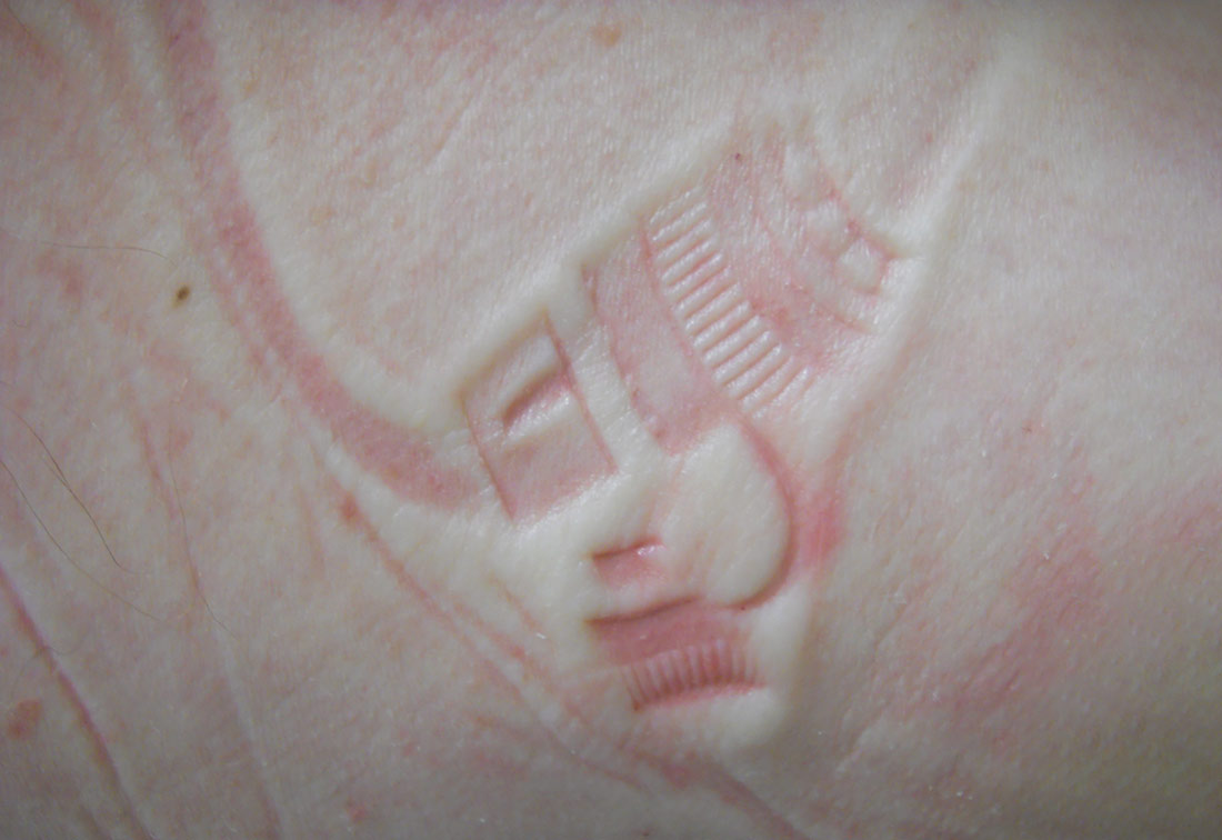Eine Druckbeschädigung auf der Haut, verursacht durch eine PEG-Sonde.