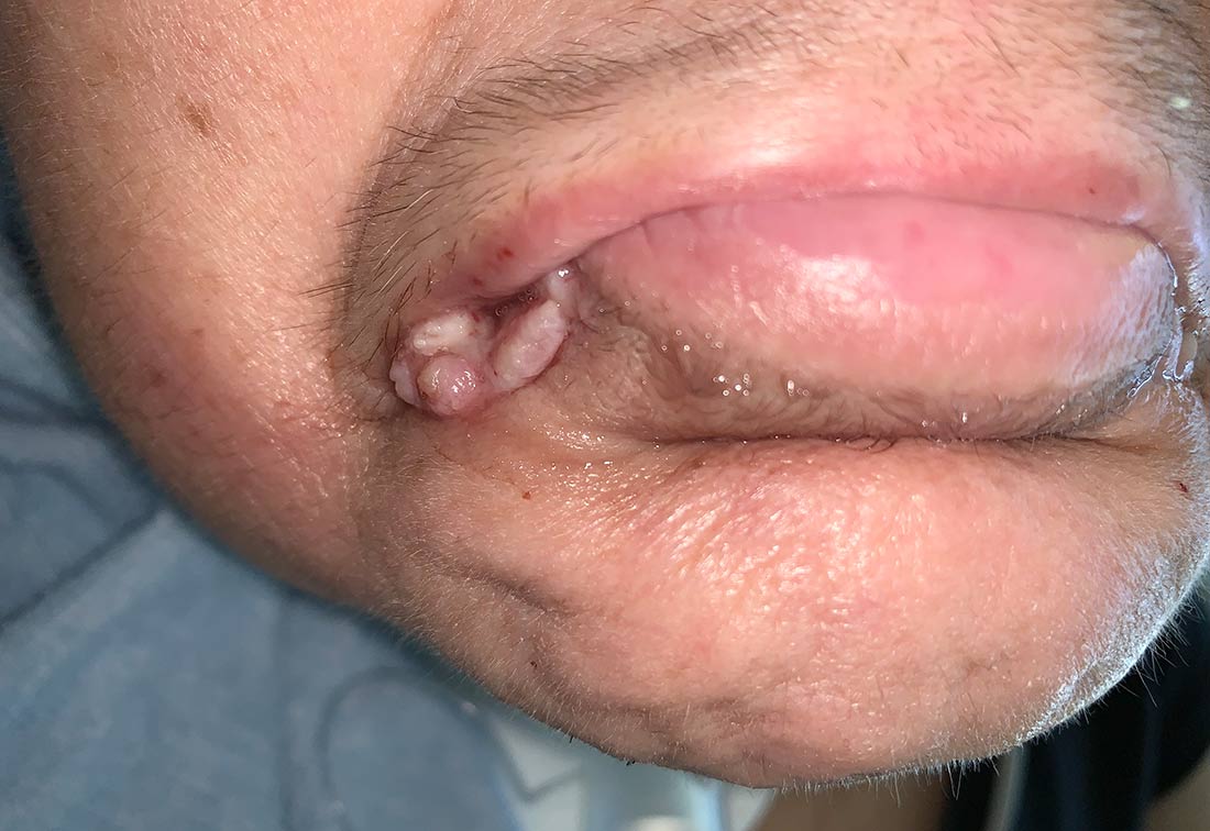 Dekubitalulceration am Mund eines Patienten entstanden durch medizinische Hilfsmittel