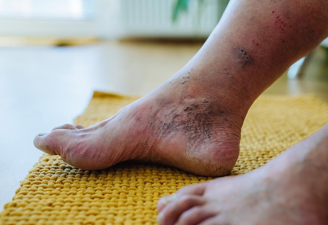 Eine Nahaufnahme der Füße eines Mannes mit diabetischen Fußsyndrom, auch diabetischer Fuß genannt.