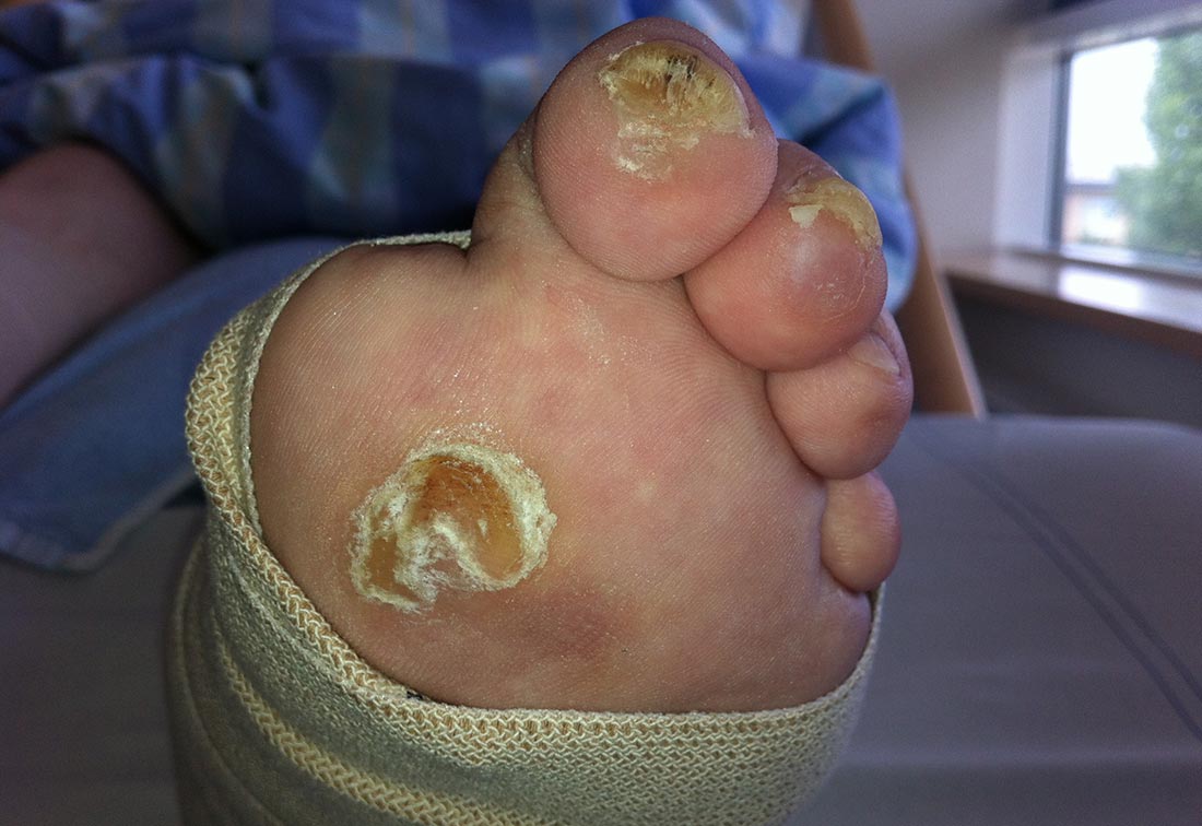 Fußsohle mit einem Malum perforans, ein typisches neuropathisches Ulkus der Fußsohle bei diabetischem Fuß