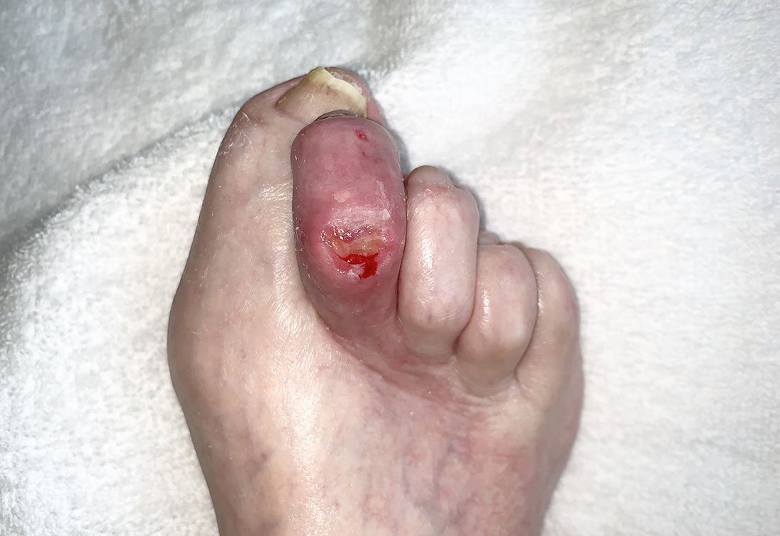 diabetischer Fuß mit Krallenzehen und Wunden