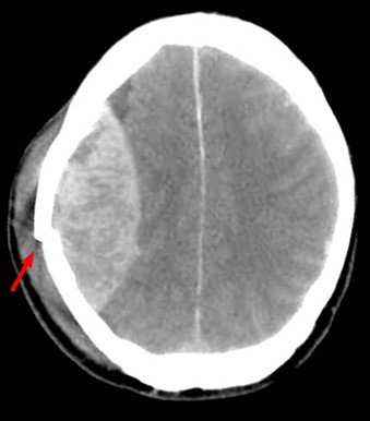Schädel-Hirn-Trauma: Röntgenbild eines Gehirns, das ein epidurales Hämatom aufweist.