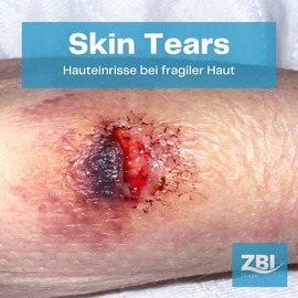 Skin Tears Hauteinrisse bei fragiler Haut Vorschaubild